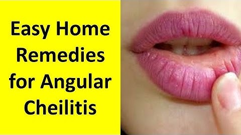 Home Remedies for Angular Cheilitis | How to Get Rid of Angular Cheilitis