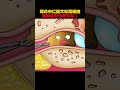 耳の中に巨大な耳垢栓綿棒はもう使うな!