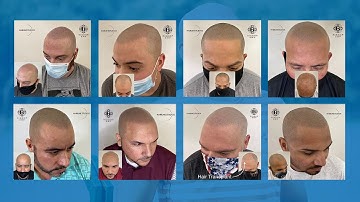 Best Scalp Micropigmentation in Orlando, FL - Hairline Studios