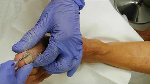 Come curare l'unghia del piede ingiallita?
