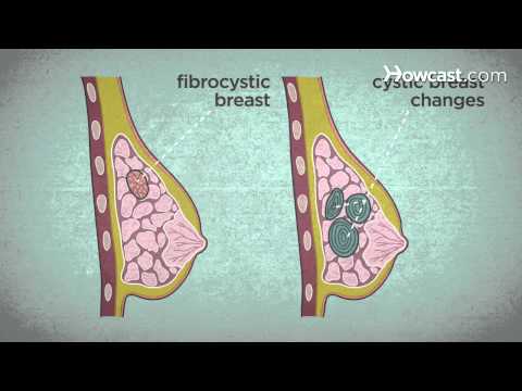 Wideo: 4 sposoby na sprawdzenie raka piersi