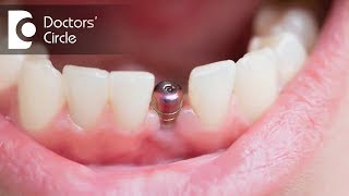 How long does it take to get a Dental Implant? - Dr. Rajeev Kumar G