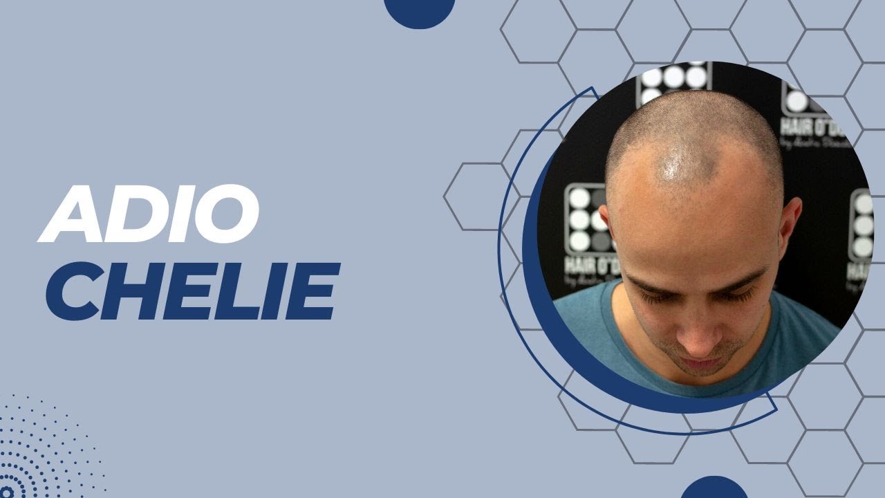 Chelie barbati micropigmentare Scalp Hairodot 