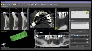 Tooth Extraction using cut Functionality in Blue Sky Plan screenshot 2