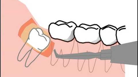 some special complications and risks of wisdom tooth extraction - a bloodless cartoon