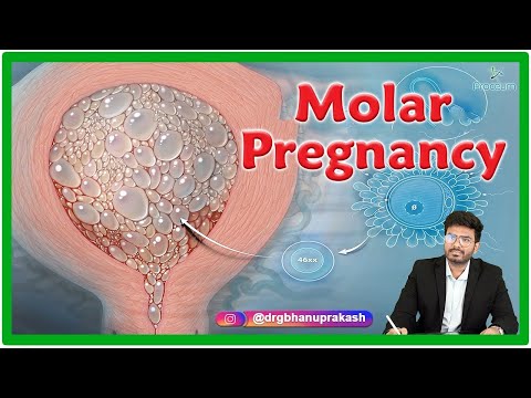 Video: Hoe om te gaan met molaire zwangerschap: 8 stappen (met afbeeldingen)