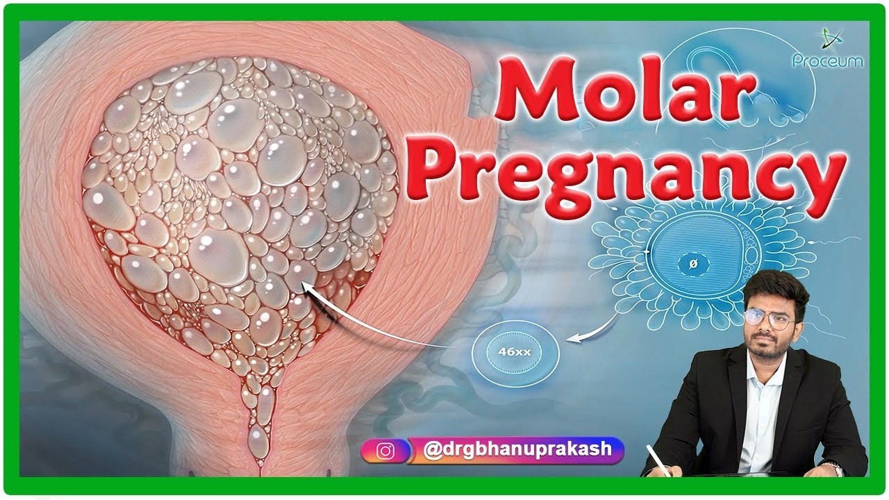 case presentation of molar pregnancy