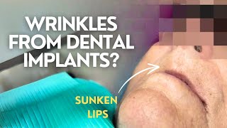How Dental Implants Affect Facial Aging
