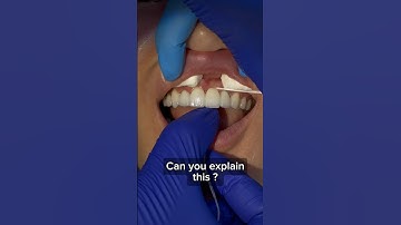 How is this possible? 🤯🦷#veneers #flosstube #flossing #satisfying #oddlysatisfying #shorts