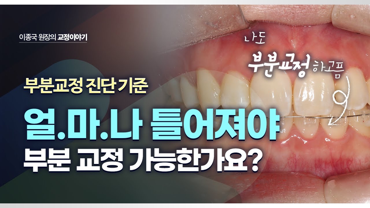 얼마나 틀어져야 부분교정이 가능한가요? 앞니부분 교정 진단 기준 총정리