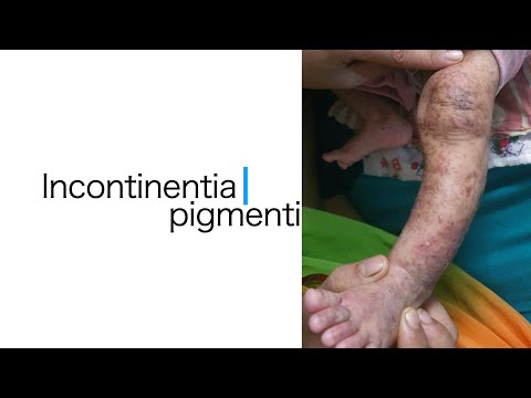 Video: Incontinentia Pigmenti Byrdeskala: Udformning Af Et Spørgeskema Til Familiebyrde