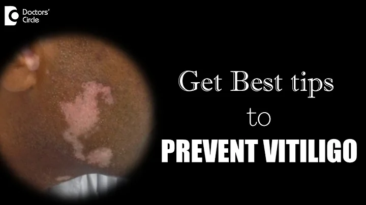 How can one prevent spreading of vitiligo? - Dr. Nischal K - DayDayNews