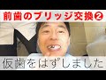 前歯のブリッジ交換②衝撃映像 仮歯を外しました｜神経を抜いた歯を修復【歯列矯正後の治療】