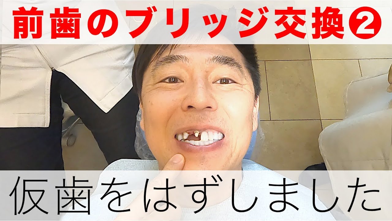 前歯のブリッジ交換②衝撃映像 仮歯を外しました｜神経を抜いた歯を修復【歯列矯正後の治療】