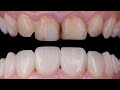 Teeth recontouring and shape perfecting by direct composite bonding teeth whitening 