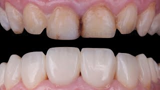 Teeth Recontouring and Shape Perfecting by direct composite bonding. (Teeth whitening )