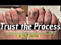 Trust The Process: Treating and Eliminating Toenail Fungus