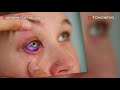 Tatuaje ocular: Modelo considera remover su ojo después que su tatuaje resultara mal - TomoNews