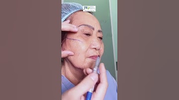 Căng da mặt SMAS CẢI LÃO HỒI XUÂN trẻ 20 tuổi cho CỤ BÀ U80