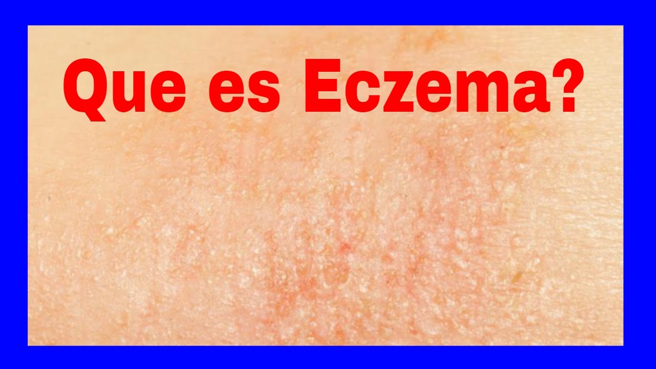 Que es Eczema Eczema Definicion YouTube