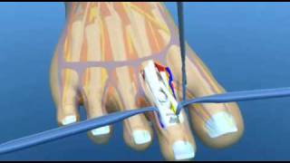 Hammer Toe Surgery Explained Podiatry Claw Toe Mallet Toe