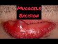 Mucocele excision on lower lip drwahanexperiment