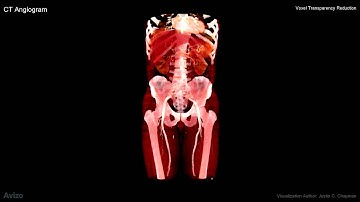 CT Visualization