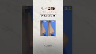 [코필러 후기를 통한 고민별 솔루션] 낮은 코 개선 #코필러 #필러 #필러후기 #필러시술 #낮은코 #코필러전후