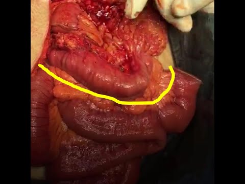 Vídeo: Diferencia Entre Intestino Y Estómago