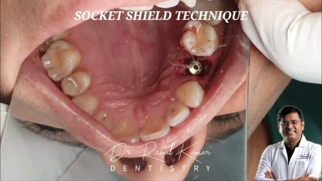 GUIDED SOCKET SHIELD TECHNIQUE OR PARTIAL EXTRACTION THERAPY YouTube