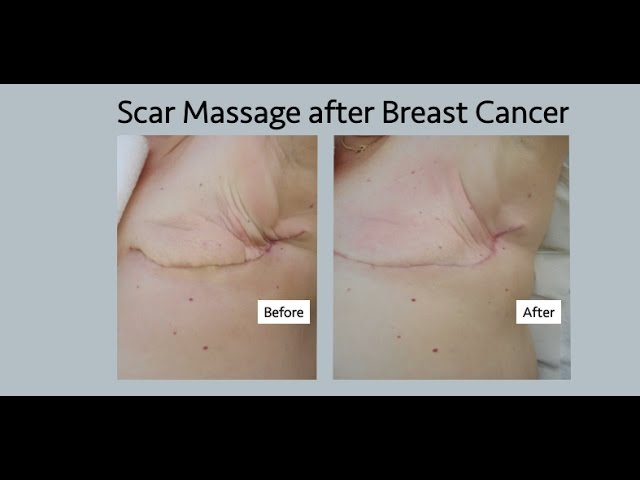 scar massage after breast cancer: mastectomy, lumpectomy and diep flap