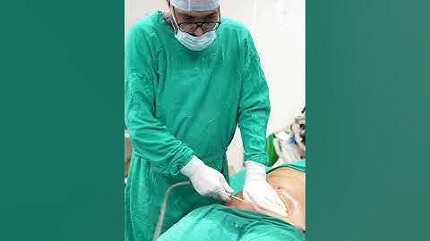 360° Abdomen Liposuction | Tummy Liposuction #shorts