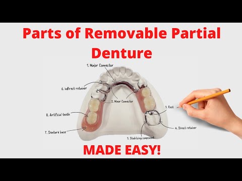 What Are Cast Partial Dentures