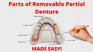Parts of Removable Partial Denture (Cast Partial Denture)