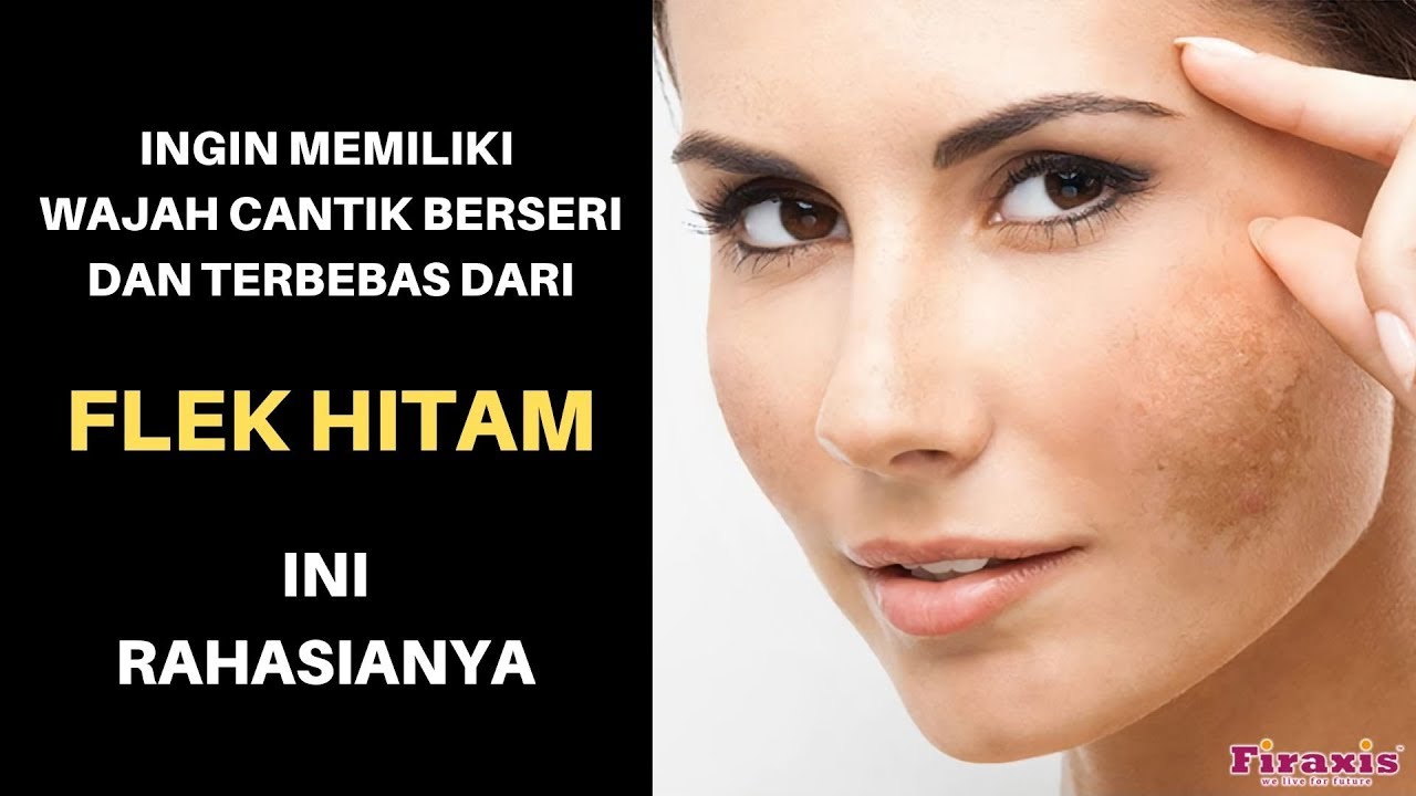 CARA MENGATASI FLEK HITAM DI WAJAH ( 0823.3569.7770 )