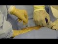 Actual surgical footage of the bmac for knee osteoarthritis procedure  mayo clinic graphic