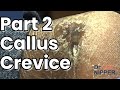 Part 2 - Callus in 60 Minutes. How to treat callus? [Callus Tuesday] (2021)