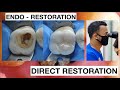 Endo Resto Dental Filling Composite Direct Restoration Upper Molar | General Dentist Griya RR