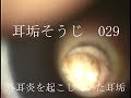 耳垢そうじ/外耳炎を起こしていた耳垢/029
