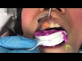 Cosmetic Dental Crown Procedure - All Ceramic Crown