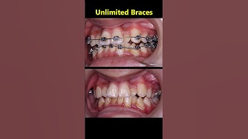 Unlimited braces. Fix crooked and crossbite teeth #braces #orthodontist #dentist