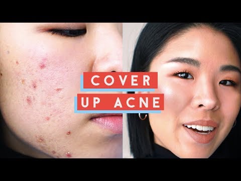 How to Cover Up Acne - My Secret to Concealing WHILE HEALING bumpy, flaky skin