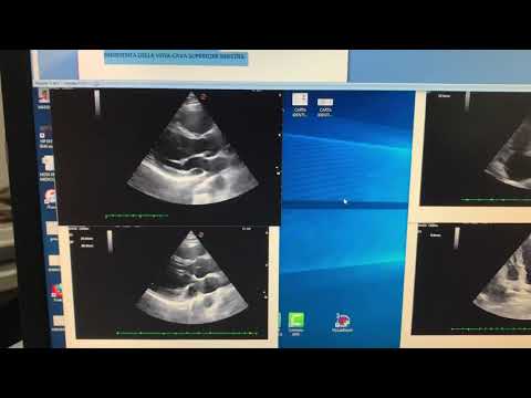 Vídeo: Estimulación Simultánea De Dos Ramas Del Seno Coronario En Un Paciente Con Válvula Tricúspide Protésica Y Bloqueo Cardíaco Completo