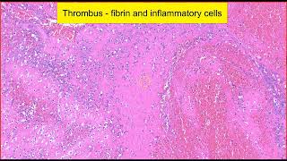 Anal canal: Haemorrhoids - Virtual microscopy (Talking slide)