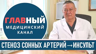 Стеноз сонной артерии: симптомы, лечение и диагностика. Атеросклеротический стеноз сонных артерий