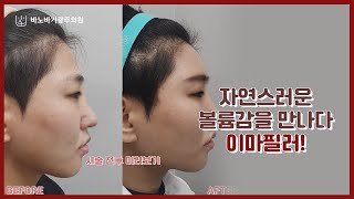 밋밋한 이마가 고민이라면 바노바기광주의원 이마필러