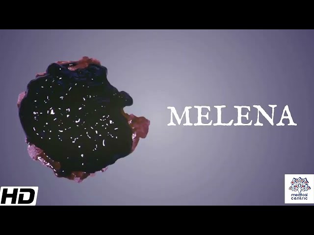 Melena Stool Human