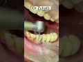 Implanted crown removal dentist shorts