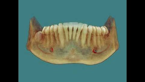 Impacted Third Molars - 3D Cone Beam CT Scan and Animation by SmartScan Imaging of Orange