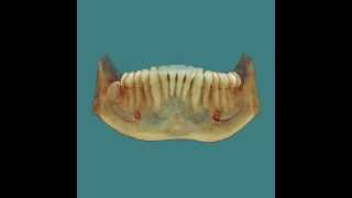 Impacted Third Molars - 3D Cone Beam CT Scan and Animation by SmartScan Imaging of Orange